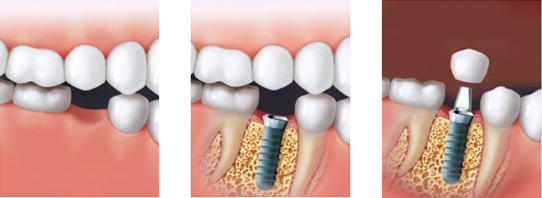 dental-implants