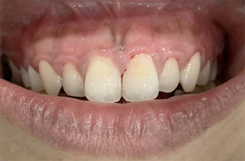 Gum Whitening after