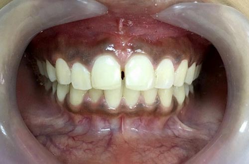 Gum Whitening 2-before