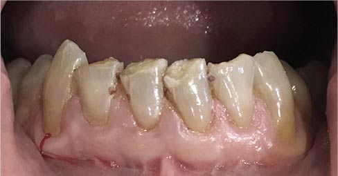 Weakened tooth structure