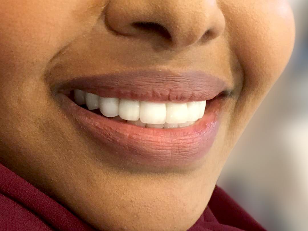 teeth whitening