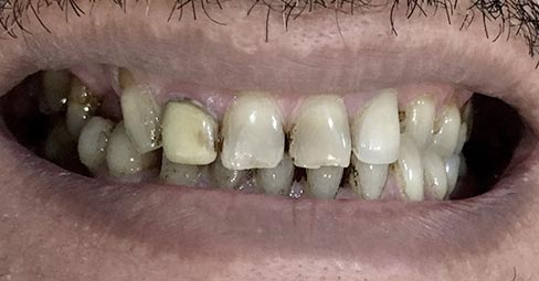 Aesthetics - Veneers Crowns Bridges