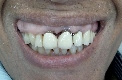 Laser Gum Treatment before