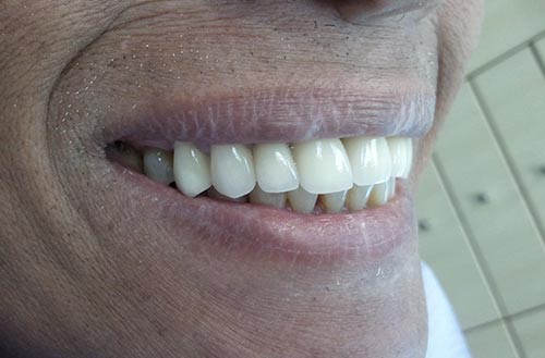 Laser Gum Treatment after